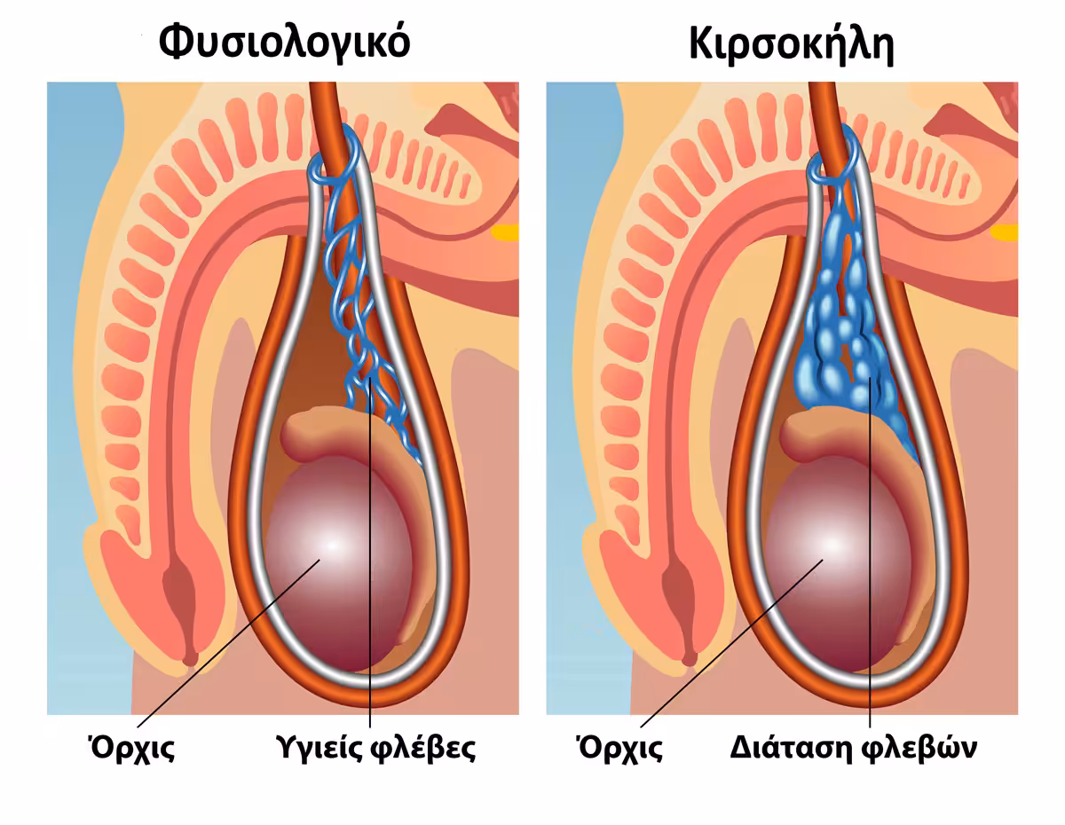 Διάταση του φλεβικού πλέγματος